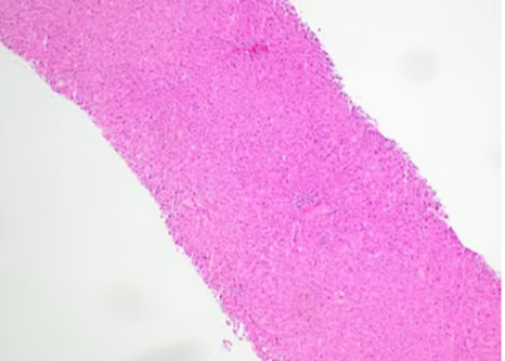 MorCor pathology vert